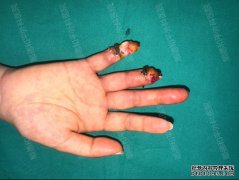 南方姑娘冰城遇险险截指，顺德和平外科医院显微再造让指尖重生